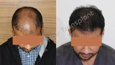 HAIR TRANSPLANT