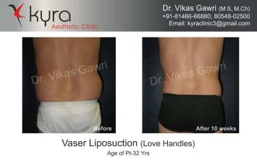 LIPOSUCTION MALE