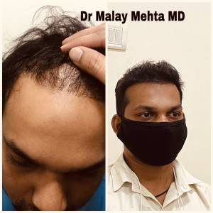 Grade of baldness 3 , Age 30 Years