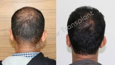 HAIR TRANSPLANT