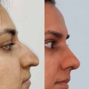 Rhinoplasty