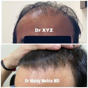 Hairline Reconstruction