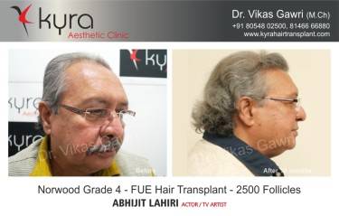 Scalp Hair Transplant