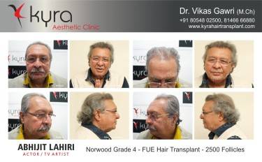 Scalp Hair Transplant