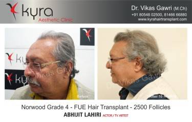 Scalp Hair Transplant