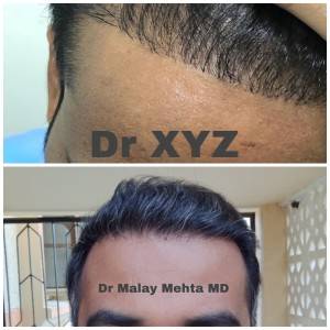 Hairline Reconstruction