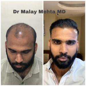 Age 28 , Grafts 5231