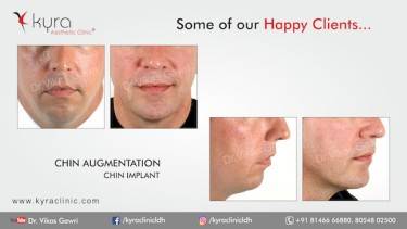 CHIN IMPLANT