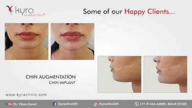 CHIN IMPLANT