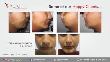 CHIN IMPLANT