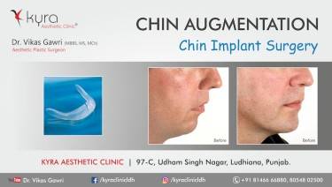 CHIN IMPLANT