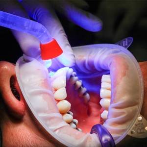 Dental-Crowns