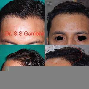 Hair Transplant