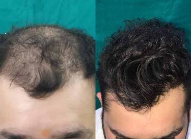 Hair Transplant