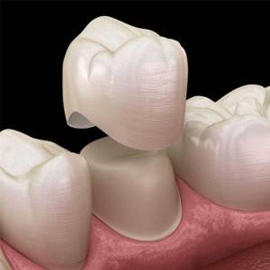 Dental-Crowns