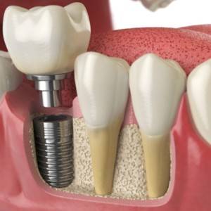 Dental-Crowns
