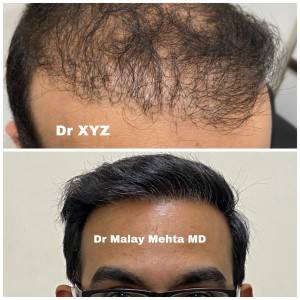 Hairline Reconstruction