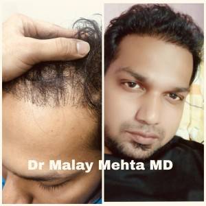 Grade of baldness 3 , Age 30 Years