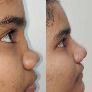 Rhinoplasty