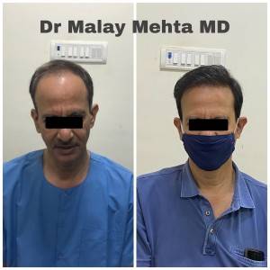 Age 55 , Grafts 4500