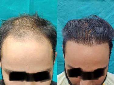 Hair Transplant