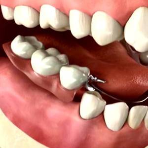 Dental-Crowns