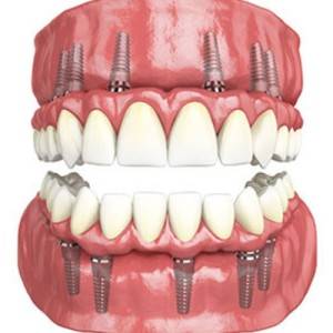 Dental-Crowns