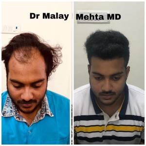 Age 28  , Grafts 3500