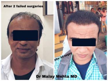 Grafts 4000 , Grade of baldness 4