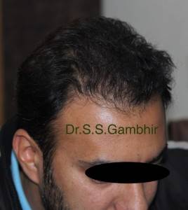 Hair Transplant