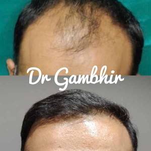 Hair Transplant