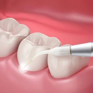Dental-Crowns