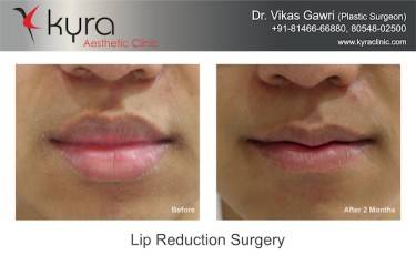 Lip Reduction Surgery