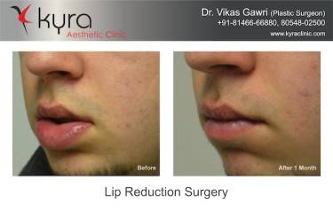 Lip Reduction Surgery
