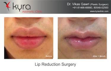 Lip Reduction Surgery