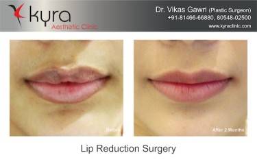 Lip Reduction Surgery