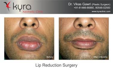 Lip Reduction Surgery