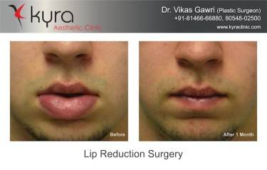 Lip Reduction Surgery