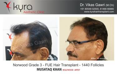 Scalp Hair Transplant