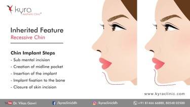 CHIN IMPLANT