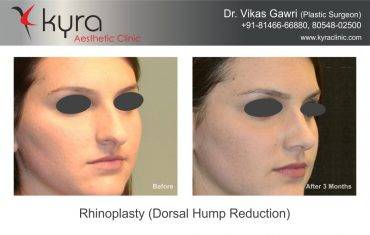 Rhinoplasty