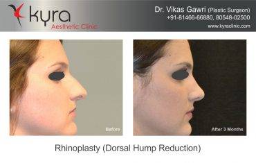 Rhinoplasty
