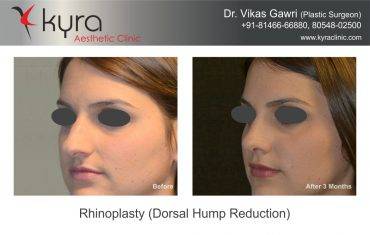 Rhinoplasty