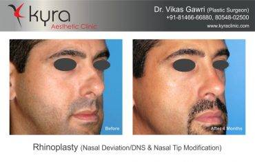 Rhinoplasty