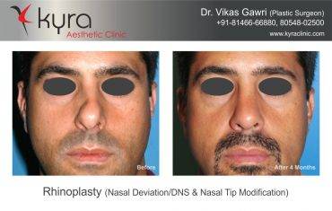 Rhinoplasty