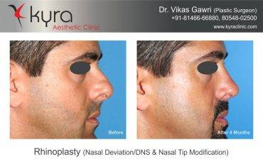Rhinoplasty