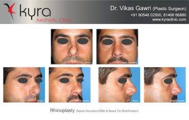 Rhinoplasty