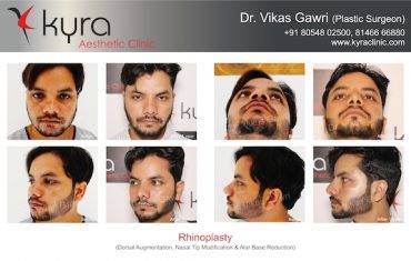 Rhinoplasty