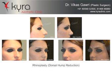 Rhinoplasty