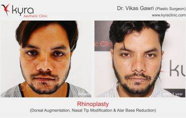 Rhinoplasty